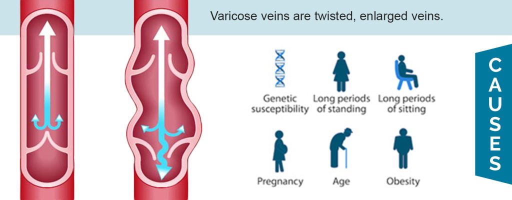 Causes of Varicose Veins - Star Magic Healing