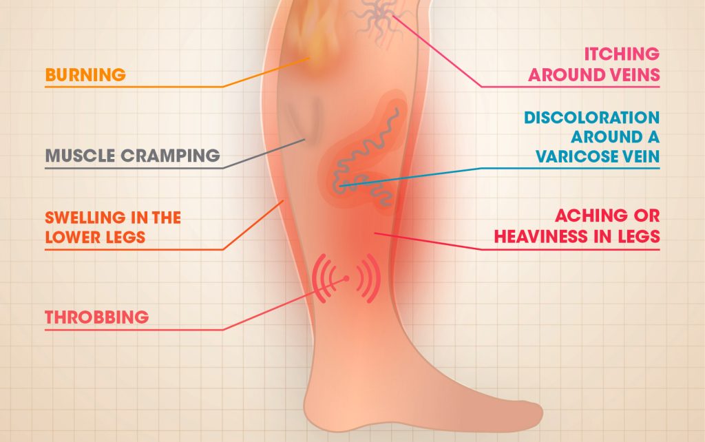 Symtoms of Varicose Veins - Star Magic Healing